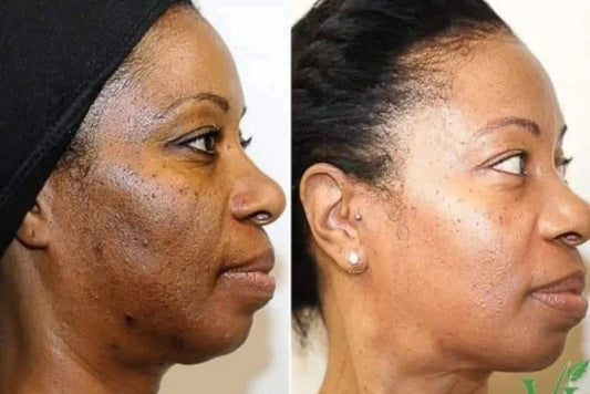 KIT: MAMI, FARDS, MELASMA